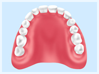 レジン床義歯(合成樹脂)
