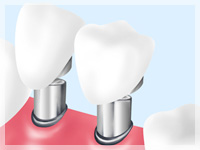 インプラント以外の治療法：咀嚼機能が回復出来る義歯